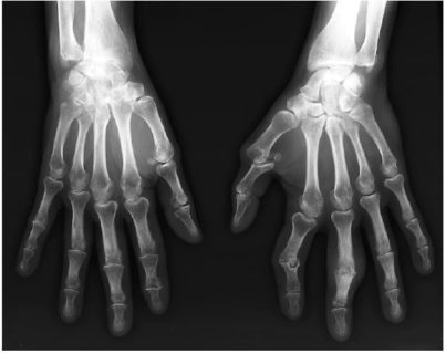 Rheumatoid Arthritis Bilateral X-ray of the hands and wrists